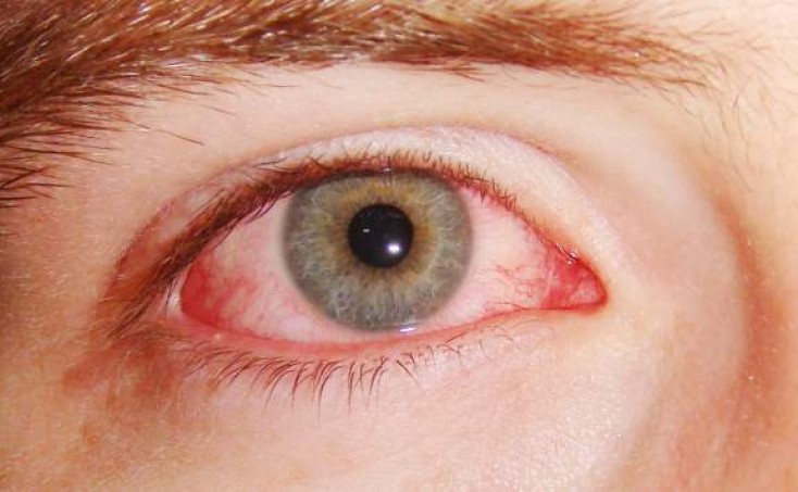 Göz allergiyasının qarşısını necə alaq?