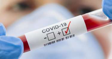 Azərbaycanda koronavirusa 102 yeni yoluxma qeydə alınıb
