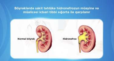 Bu xəstəliyin müalicəsini icbari tibbi sığorta qarşılayır
