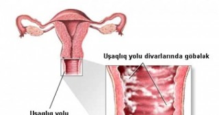 Qadınlarda göbələk xəstəliyi