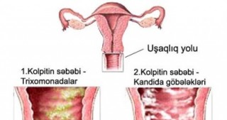 Kolpit xəstəliyi haqqında