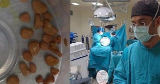 Böyrəklərindən 56 daş çıxarıldı- 5 aylıq körpə... / FOTOLAR