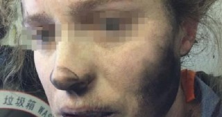 Musiqi dinləyərkən qulaqcıq partladı
