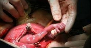 Abort olunan döl həkimin əlindən tutdu