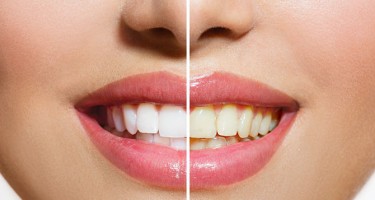 Dişləri ağartmaq üçün təbii üsullar