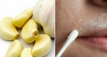 Epilyasiyaya getmədən tüklərdən xilas olun