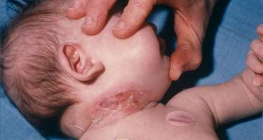Difteriya epidemiyası 91 can aldı