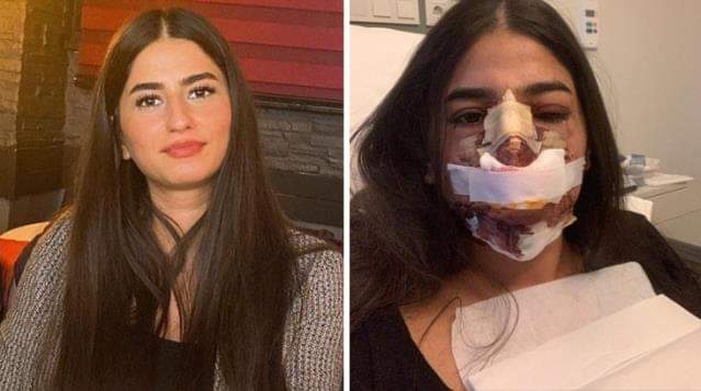 Gözəlləşmək istəyən nişanlı qız əməliyyatdan sonra TANINMAZ HALA düşdü - 