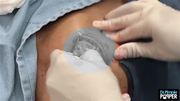 Kürəyindən çıxanlar hər kəsi TƏƏCCÜBLƏNDİRDİ